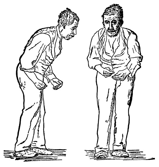 Nervous System Disorders